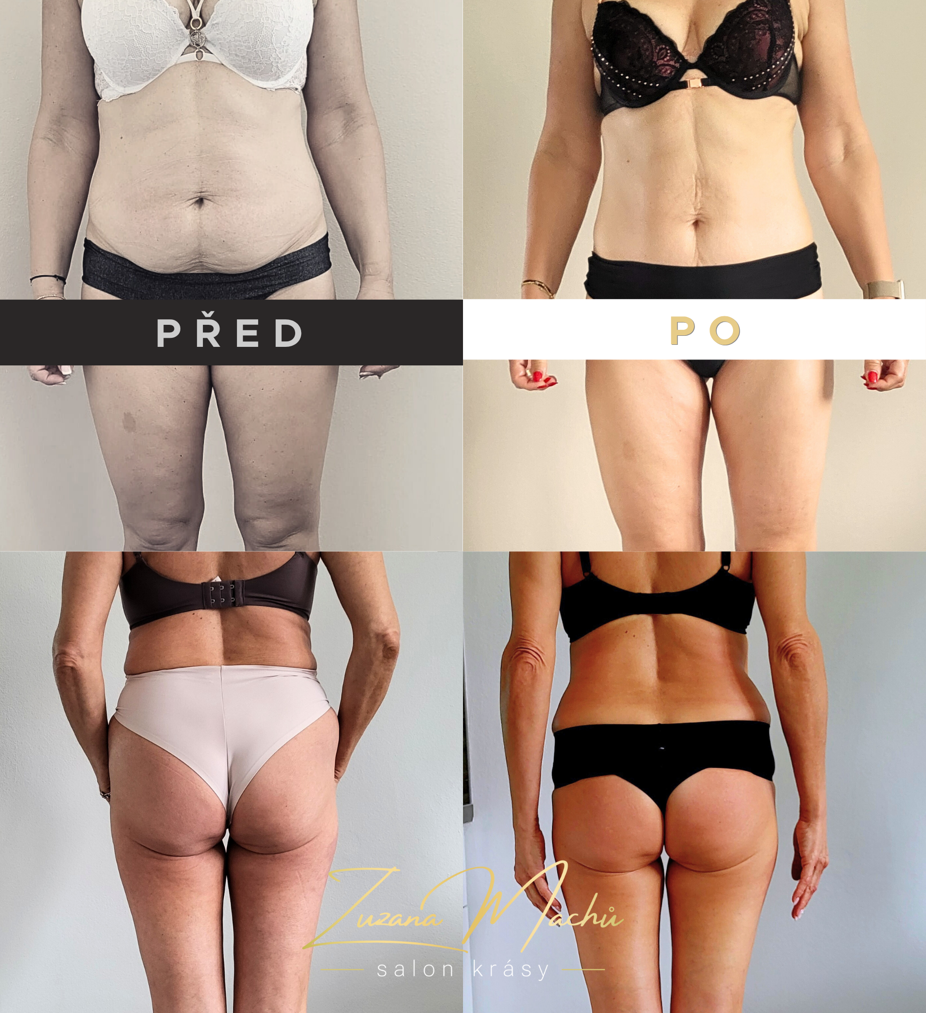 Maderoterapie před a po