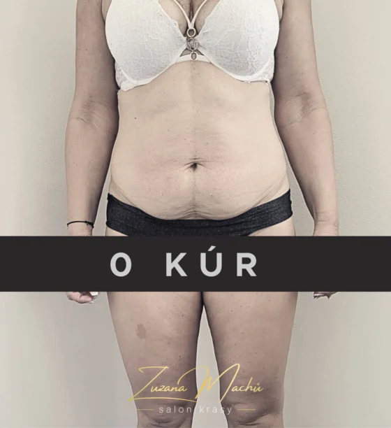 Maderoterapie a lymfomodeling před