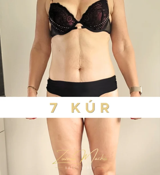 Maderoterapie a lymfomodeling po