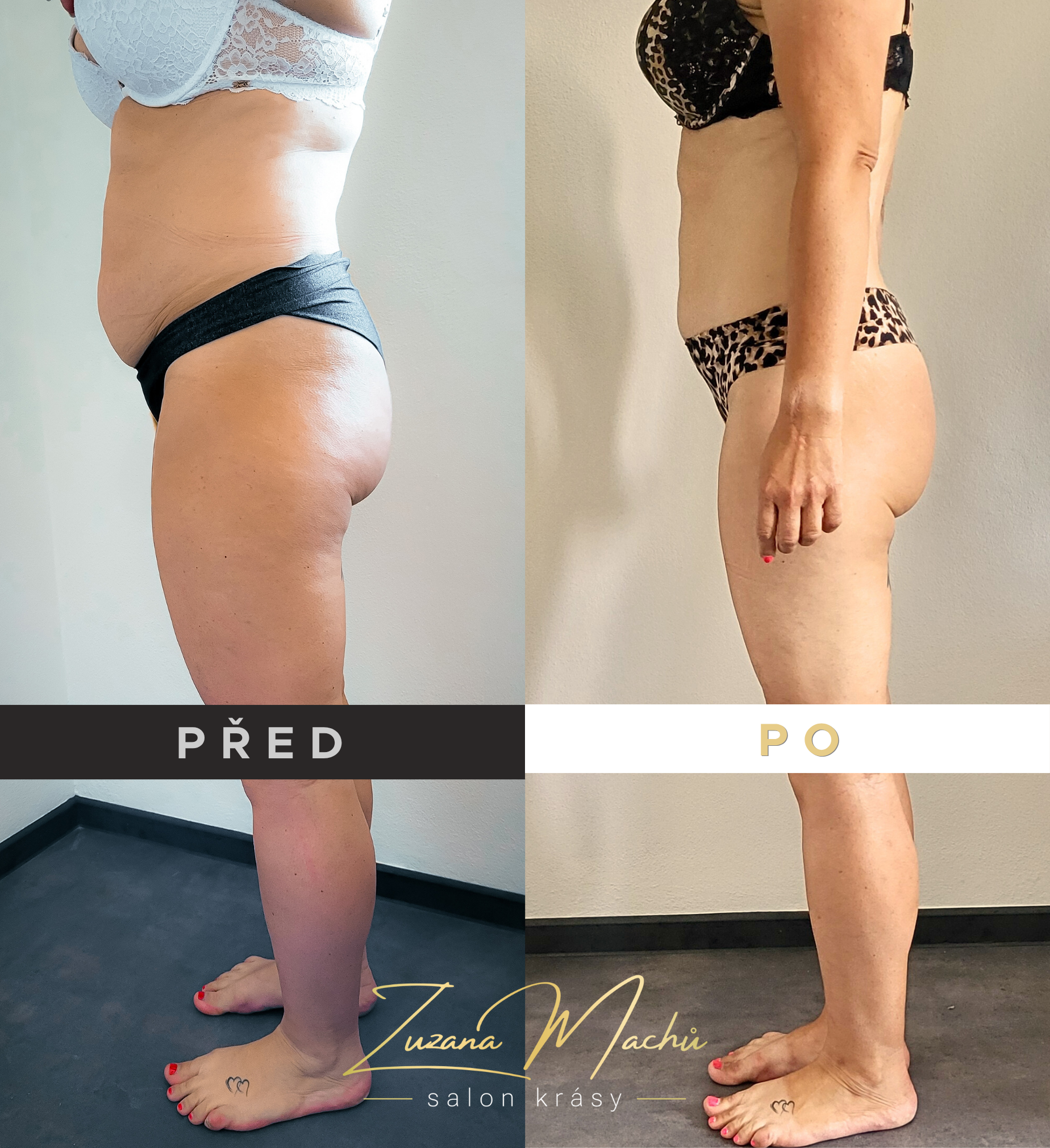 Výsledky maderoterapie před a po